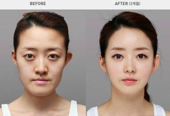 south korea plastic surgery